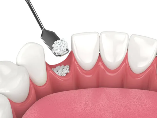 Bone grafting for dental implant