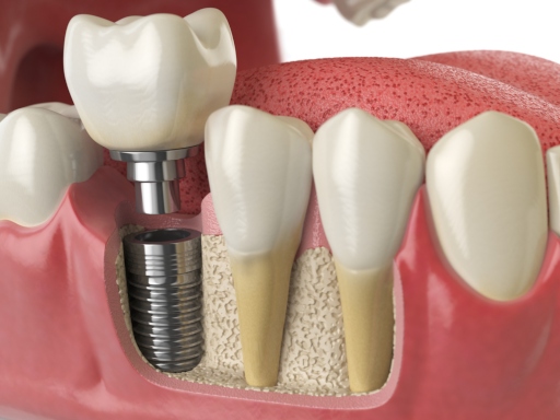 tooth dental implant in human dentura