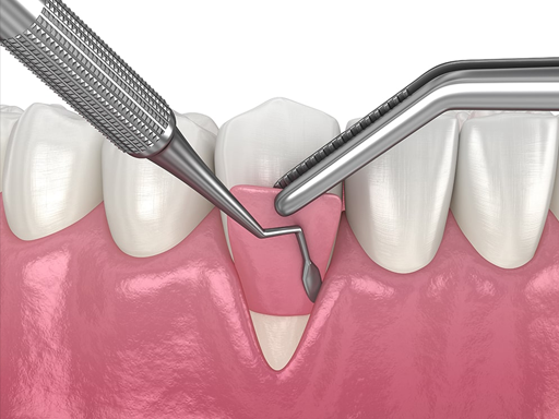 Gingival Grafting