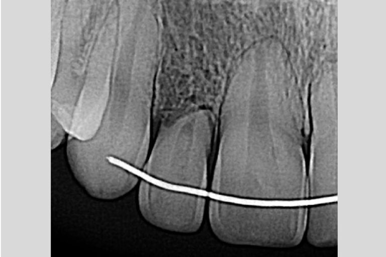 A 20-year-old female with a front tooth that needs to be extracted
