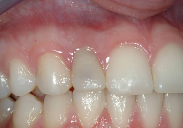 A temporary crown for teeth