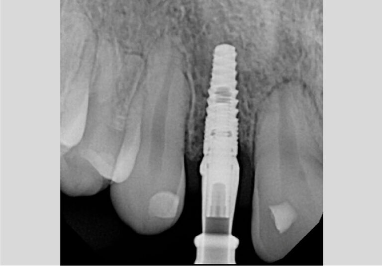 An x-ray of the implant after it was placed