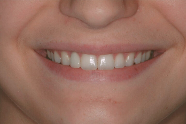 A woman smiling with dental implants